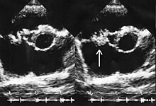 Side-by-side echocardiogram cross-sections of a human heart. In the second image a white arrow points at a mass on the tricuspid valve.