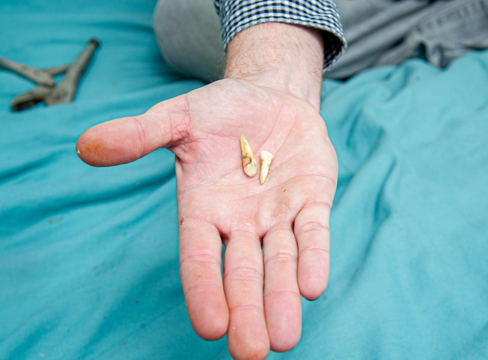 He ended up pulling out two teeth at home in Portsmouth